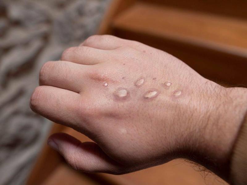 Una familia estaba bajo sospechas de viruela del mono en Lempira.