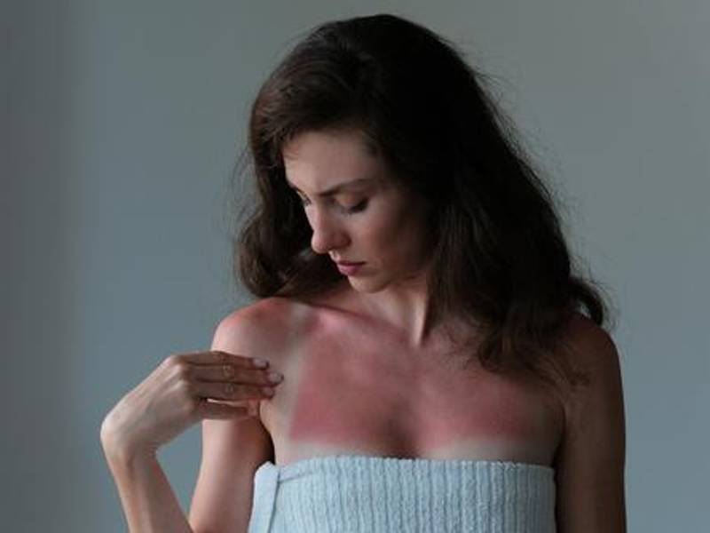 Las personas de piel clara tienen mayor riesgo de quemarse.