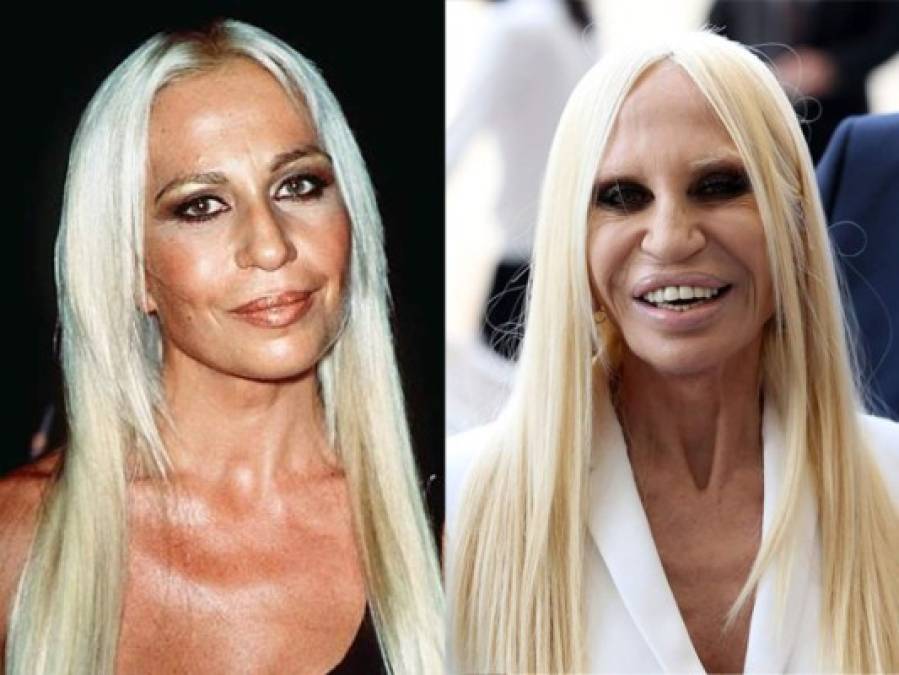 Donatella Versace: Se aferró a permanecer joven y bella el mayor tiempo posible. A sus más 60 años, la famosa diseñadora desearía lucir perfecta, pero en su afán ha deformado completamente sus rasgos.<br/>