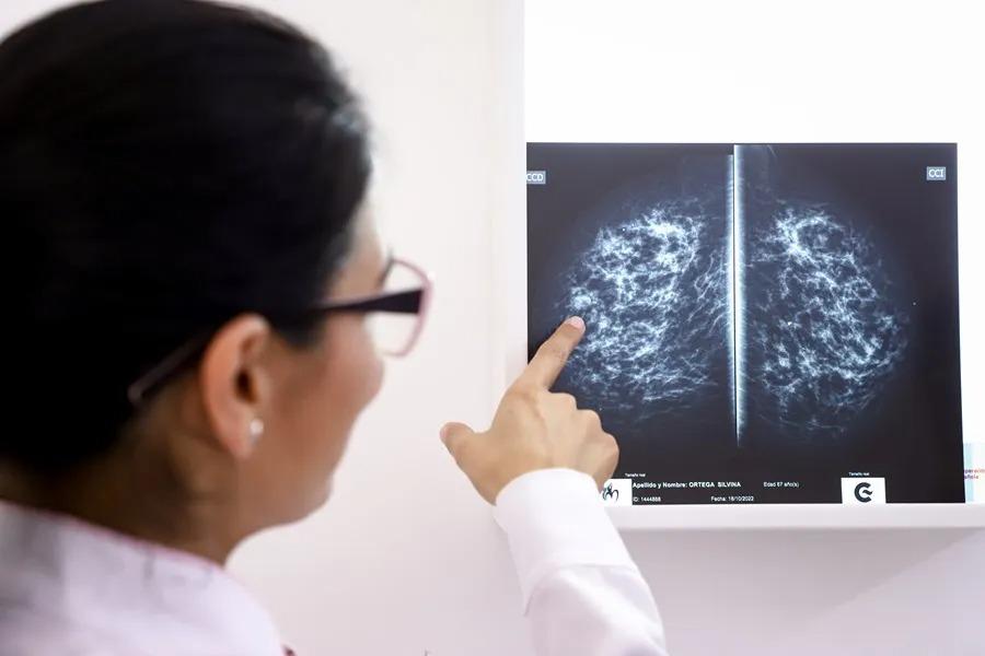 La OMS lanza portal con IA para alertar sobre el vínculo entre alcohol y cáncer de mama