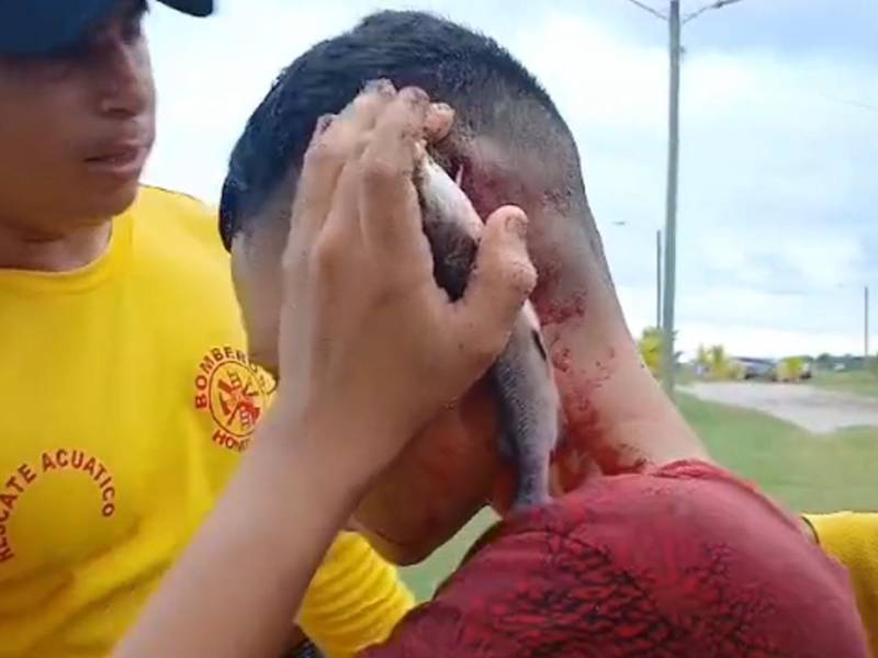 Joven hondureño termina con un pez incrustado en la cabeza