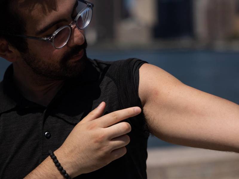 Kyle Planck, de 26 años de edad, se acaba de recuperar de la viruela del mono y afirma que sufrió los peores dolores de su vida con la enfermedad.