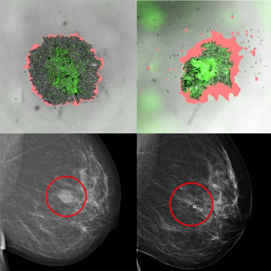 Los investigadores desarrollaron y probaron modelos de cultivo de células tumorales completas derivadas de pacientes con cáncer de mama que pueden predecir cómo responderán los tumores a distintos tratamientos.