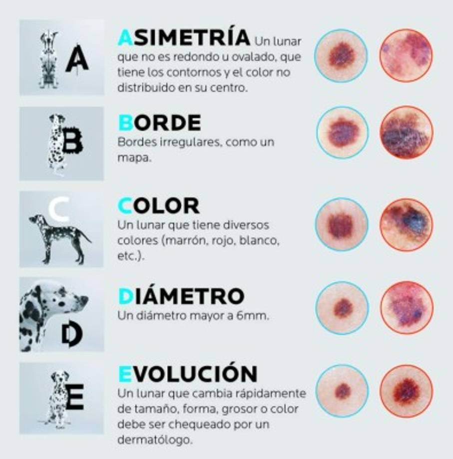 Conoce la regla del ABCDE<br/><br/>Realiza regularmente mínimo 3 veces por año un auto examen de tu piel para reconocer los signos sospechosos en cuanto aparezcan. Es fácil realizarla, solo ayúdate con un espejo, o alguien de tu confianza, siguiendo la “regla del ABCDE”, la que nos de la diferencia entre un lunar y un melanoma.<br/><br/><br/>La presencia de uno o más de estos criterios no significa que tengas un melanoma, pero tampoco debe ser ignorada: a la más mínima duda, consulta a tu dermatólogo.<br/><br/>