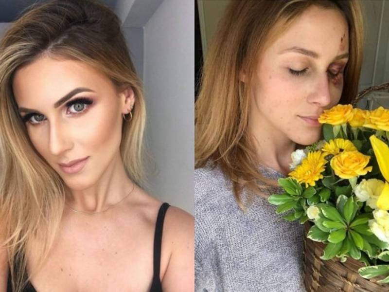 Melissa Gentz, una brasileña de 22 años que actualmente estudia y reside en Florida (EE.UU.), ha causado revuelo en las últimas horas al denunciar la terrible paliza que sufrió por parte de su novio, un destacado deportista. FOTOS INSTAGRAM.