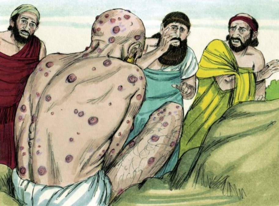 La lepra es mencionada con mucha frecuencia en los libros del antiguo testamento, hasta Moisés se dice en la biblia que tuvo lepra.