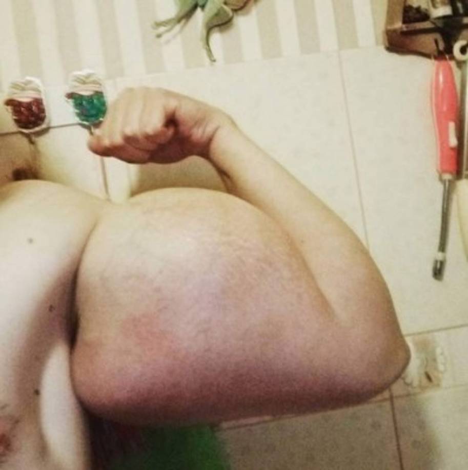 El oriundo de Pyatigorsk, en Rusia, aumenta día a día sus músculos, producto del consumo de Synthol inyectable.