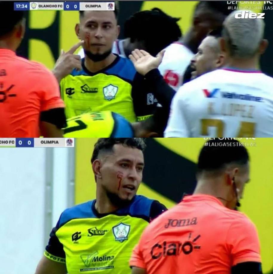 Erick Andino le mostró al árbitro Nelson Salgado la herida que sufrió, pero el árbitro solo pitó falta. No mostró tarjeta.