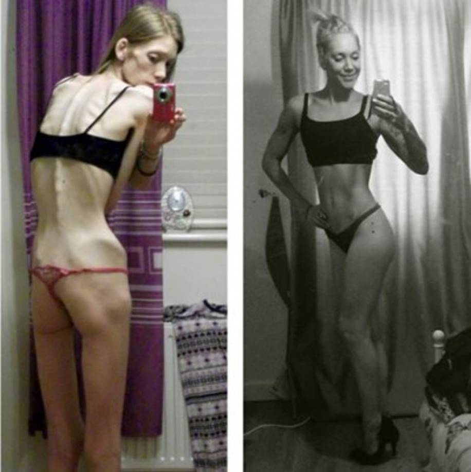 Tan sólo 18 meses le bastaron a la joven británica para tonificar su cuerpo, para revivirlo de aquella enfermedad.