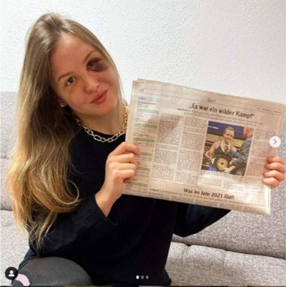 En el costado izquierdo de la cara de Hanson, sobre todo al lado del ojo, se le generó una inflamación que genera escalofríos. Incluso, ella misma subió una fotografía del antes y el después de su cabeza y es impactante el cambio que se observa.