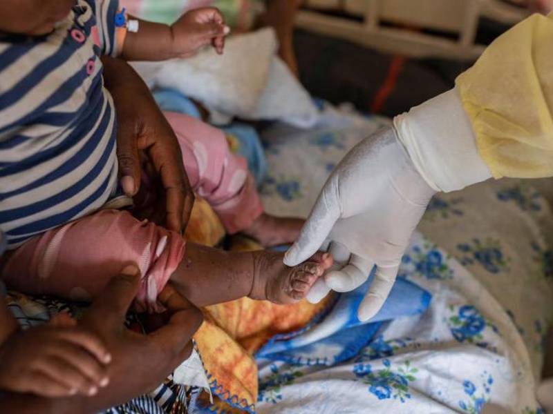 La viruela del mono es una enfermedad poco frecuente que afecta principalmente a roedores, como ratas y ratones, así como a primates no humanos, incluidos los monos. Sin embargo, este virus también puede infectar a las personas.