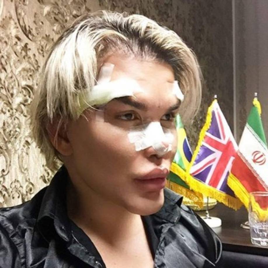 Lo último que se arregló Rodrigo Alves en el quirófano, fueron los ojos, nariz, dientes y barbilla, y según escribió en Instagram, solo está esperando a sanar por completo antes de publicar una selfie con su nuevo look.<br/> <br/>