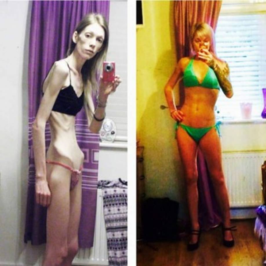 Al borde de la muerte, se vio obligada a recorrer distintos hospitales. Su peso apenas alcanzaba los 25 kilos y su indice de masa corporal era de una niña de ocho años. Los médicos llegaron a confirmarle a la familia que algunos de sus órganos vitales habían empezado a dejar de funcionar.