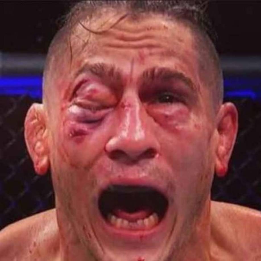 Así quedó la cara desfigurada de Niko Price luego de una impactante derrota por nocaut.