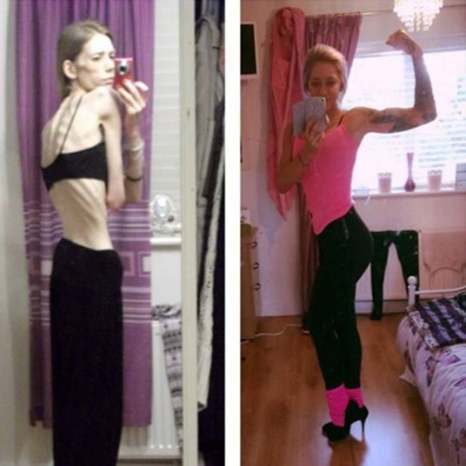 Hasta hace seis años atrás, la joven británica Nicola King tenía pocas posibilidades de sobrevivir. Su cabello se había caído, sus períodos menstruales habían desaparecido y el constante dolor corporal aumentaba.