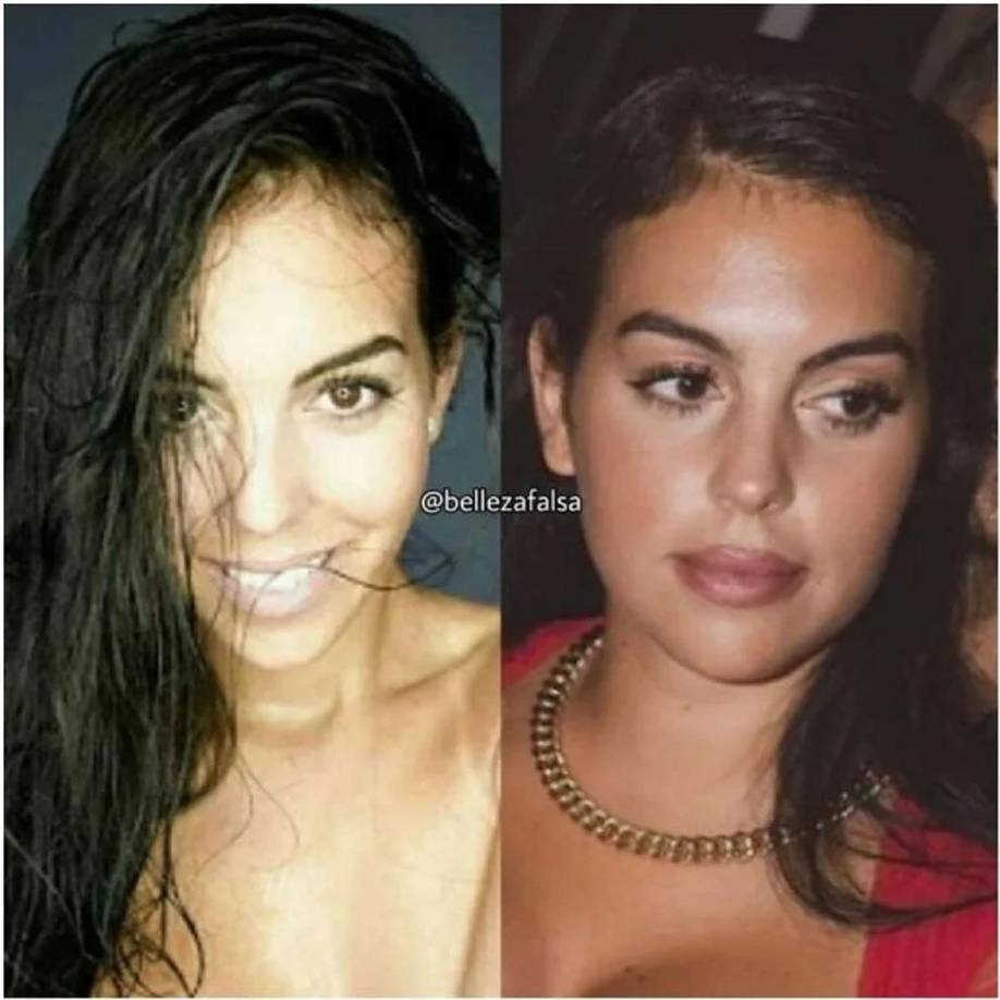 La rinoplastia es una intervención quirúrgica en la que se resuelven principalmente los problemas estéticos de la nariz, y las fotos del pasado de Gio se han vuelto virales en redes sociales.