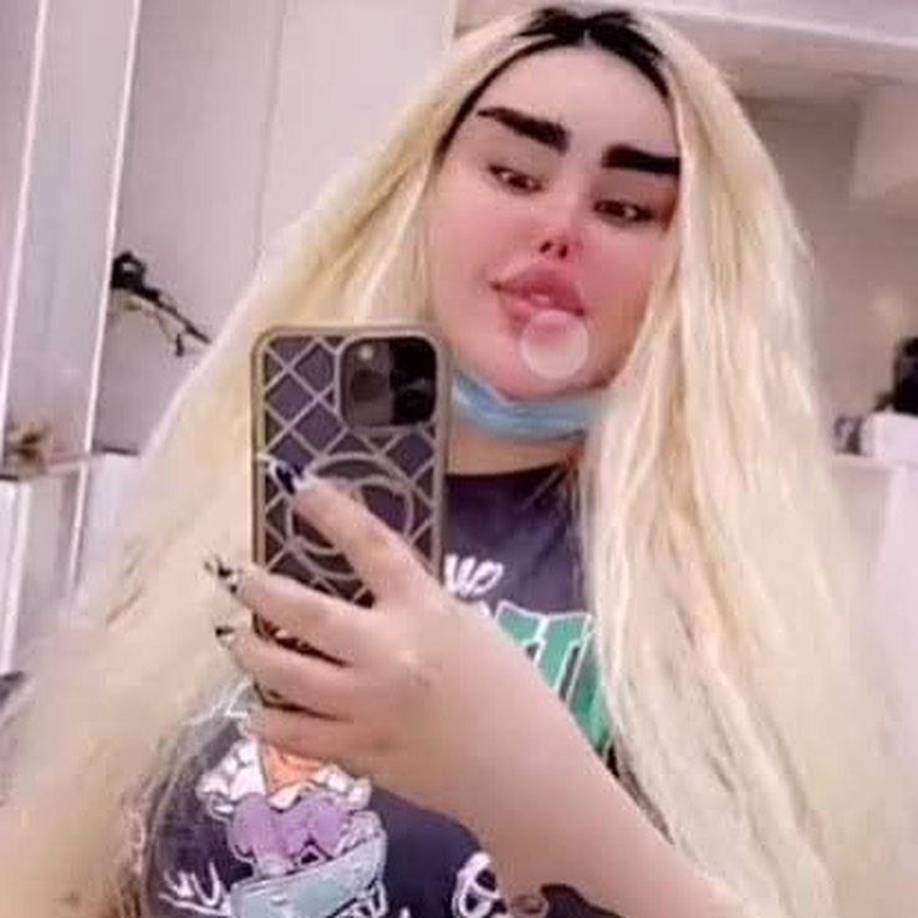 De acuerdo al periódico ‘The Sun’, Dalia supuestamente se ha sometido a 43 cirugías en total para lograr su sueño de ser una Barbie de carne y hueso.