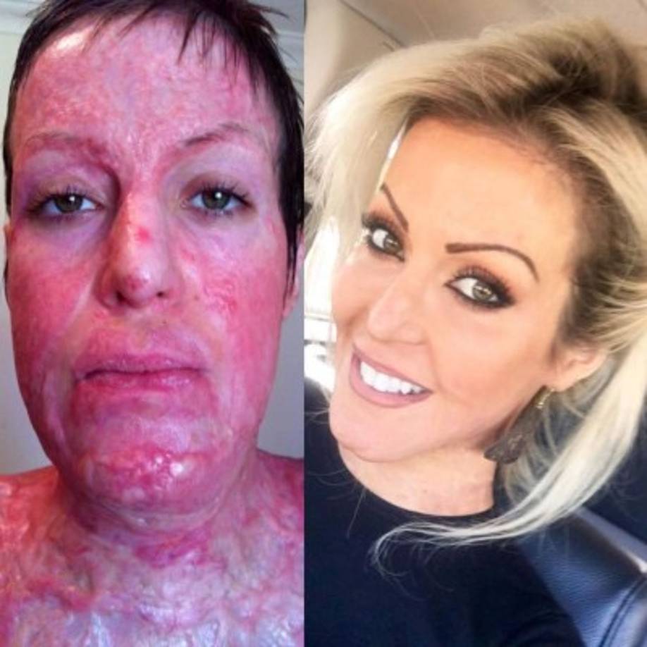 Tras el ataque, el cuerpo de Dana quedó dañado en un 60 por cierto con quemaduras de tercer grado.