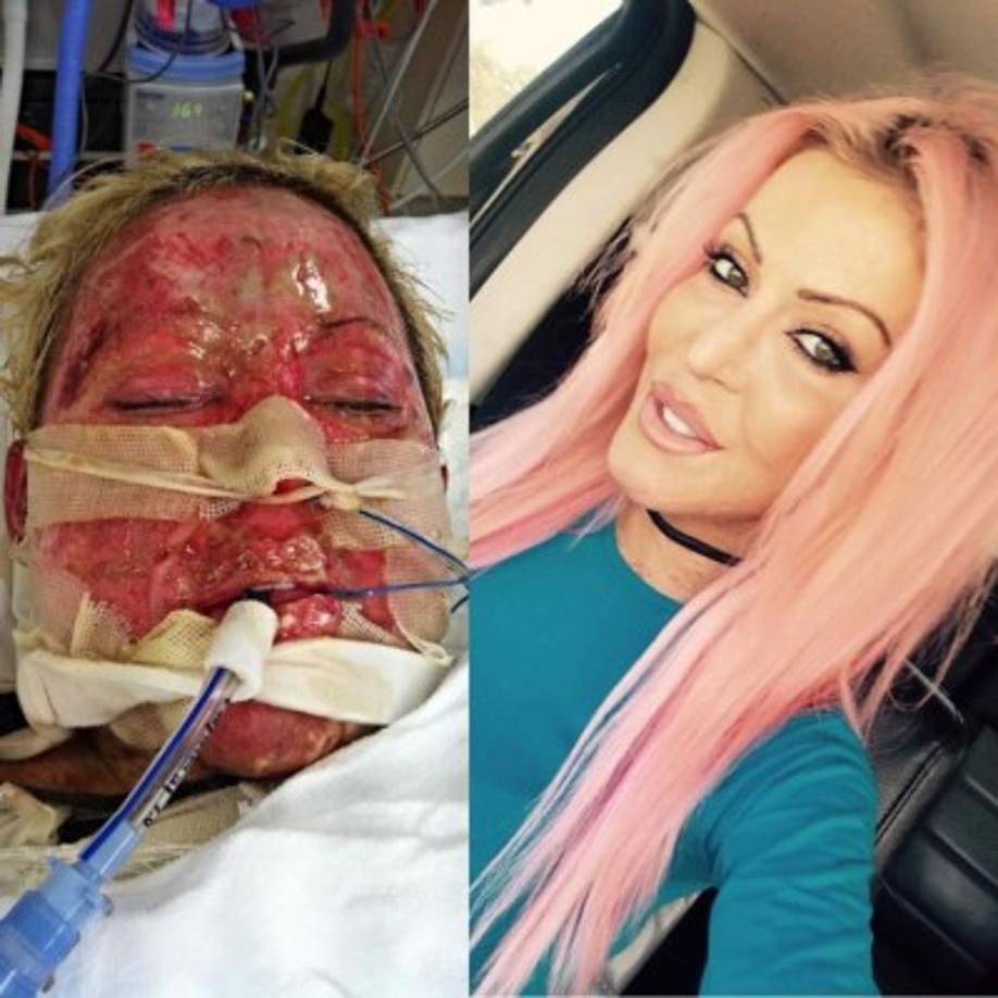 Tras quemarla, Natalie fue sentenciada a 17 años en prisión mientras Dana comenzaba una terapia que la llevó a estar casi dos años en el hospital y tres usando vendas de compresión para sanar las heridas. <br/>