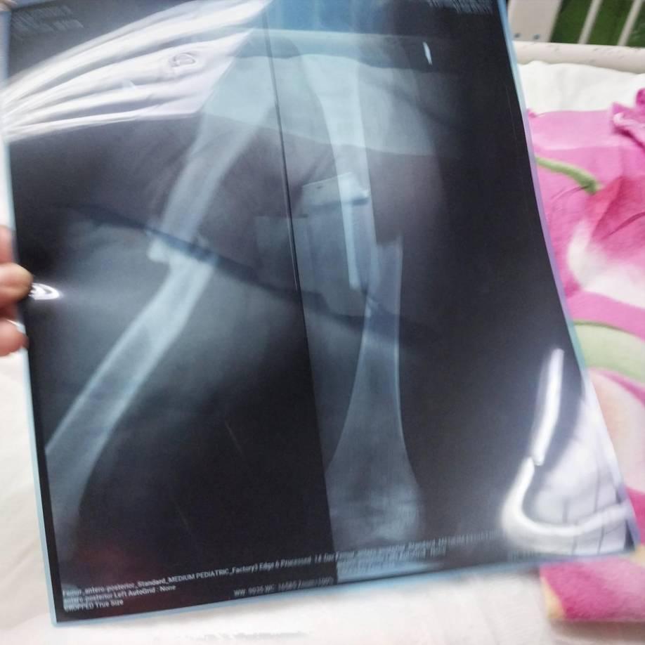 Rayos x de las dos piernitas de Fernanda, quien tuvo que pasar su cumpleaños cinco, el sábado 21 de diciembre, en un hospital.