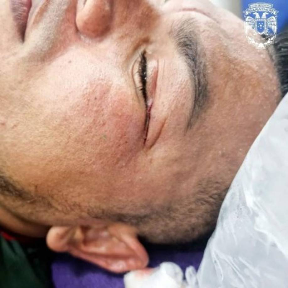 Mario Martínez recibió varios puntos de sutura por el codazo que le dio Jonathan Paz.