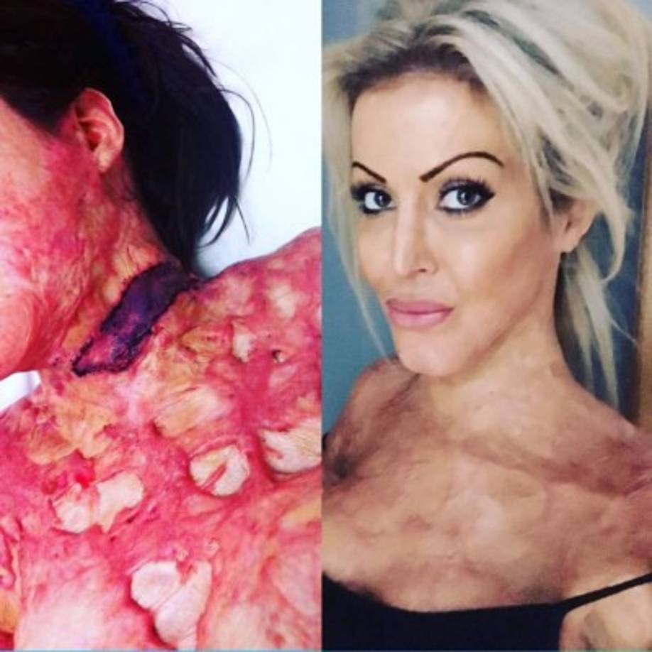 'El dolor era insoportable, pero pude oír a Natalie y Daniel escapar por la puerta... Se estaban riendo de mí mientras me quemaba viva.' dijo Dana.