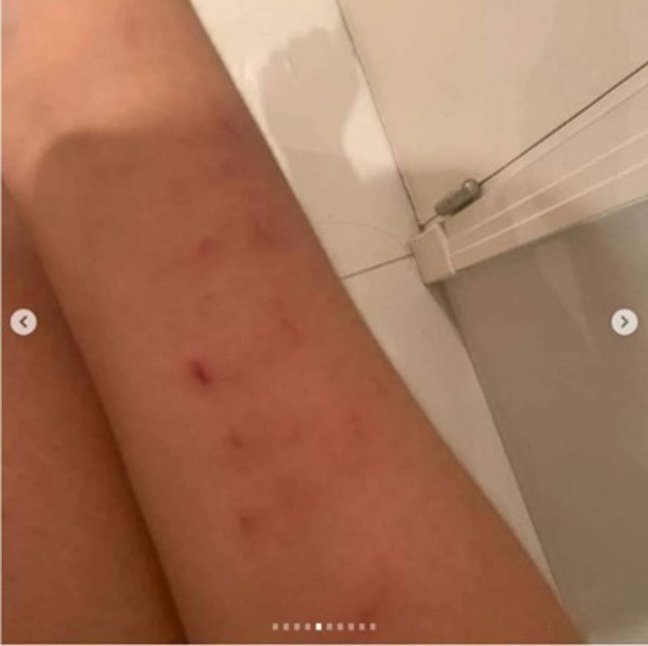 Daniela Cortés mostró en su cuenta de Instagram las marcas que le dejó Sebastián Villa.