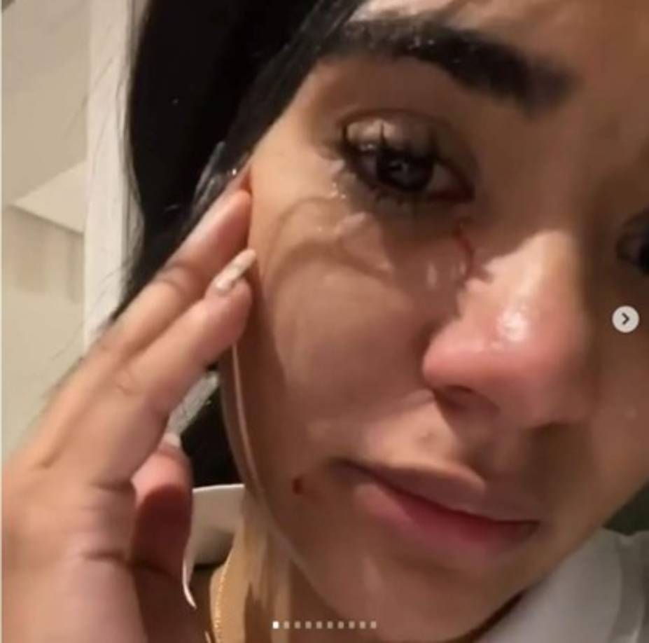 Daniela Cortés, novia del delantero de Boca, publicó fotos en las que muestra las lesiones que le habría producido el futbolista.