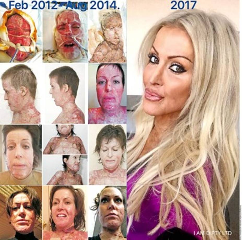 Luego de diversas intervenciones por fin, después de cinco años, esta semana pudo volver a su vida 'normal'.