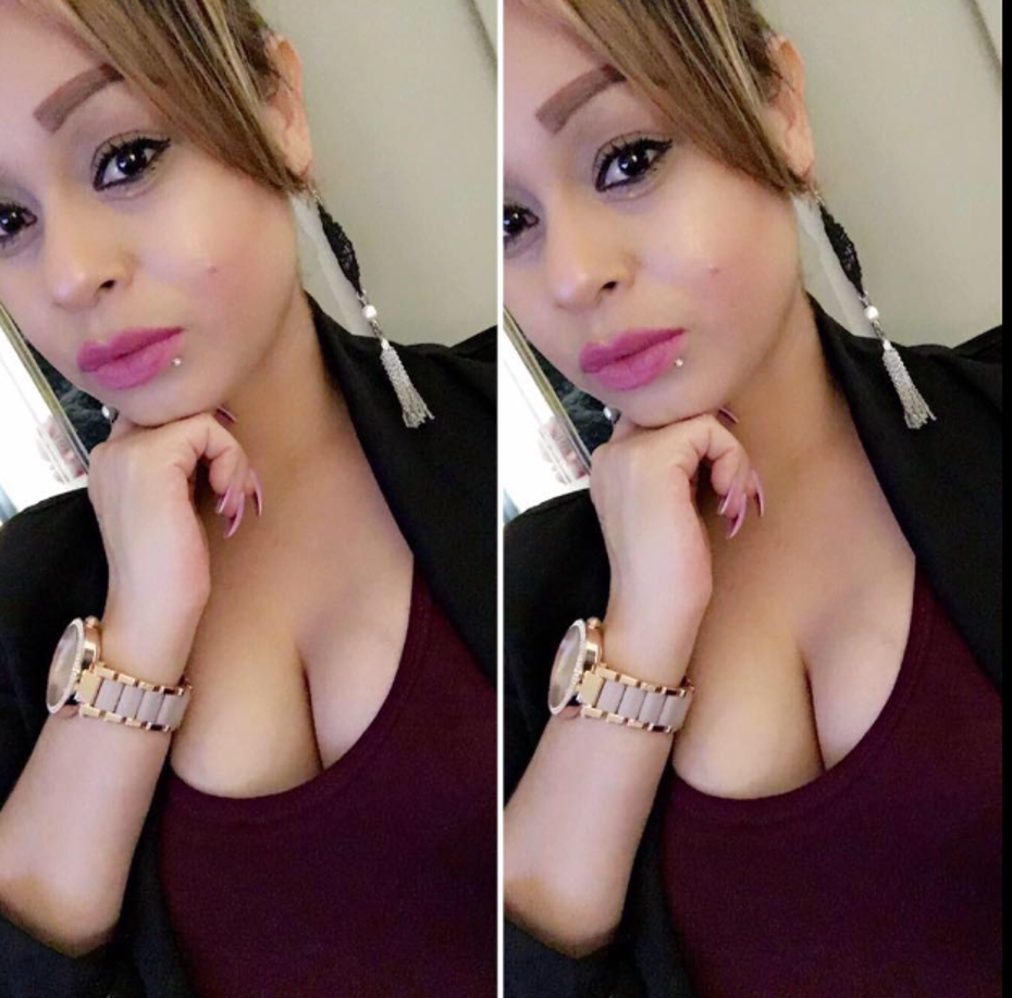 Los síntomas comunes de la infección por Vibrio vulnificus incluyen: Dolor abdominal, fiebre y escalofríos, náuseas y vómitos, ampollas en la piel, enrojecimiento e inflamación de la piel, dolor e hinchazón en la zona afectada, sSíntomas sistémicos graves.