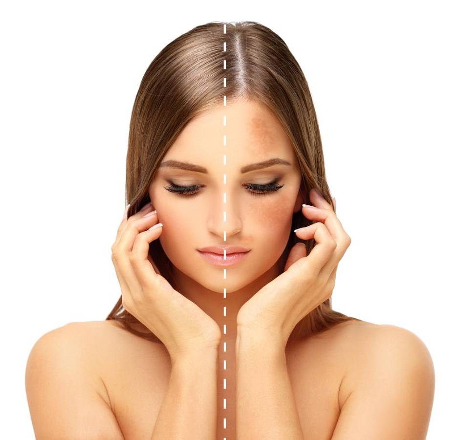 El melasma no está necesariamente relacionado a problemas graves de salud.