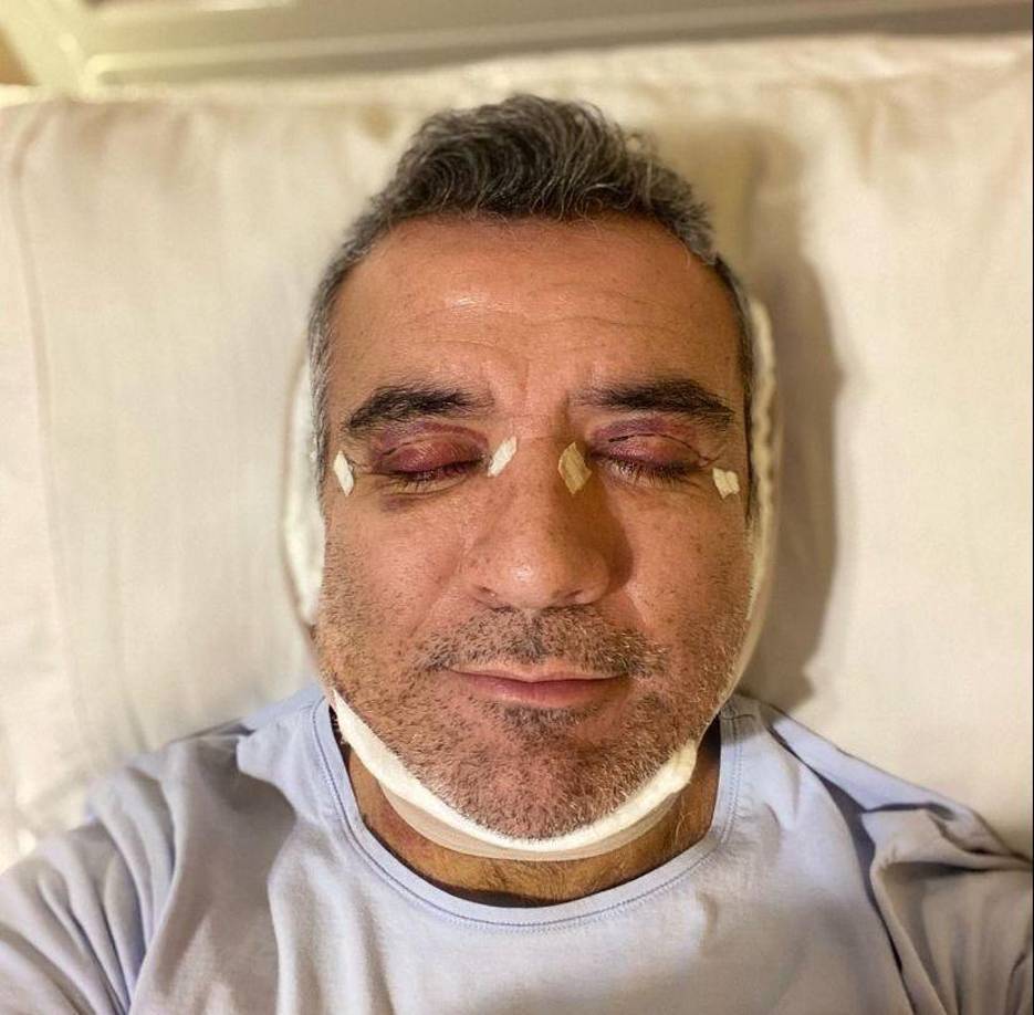 “Tengo 55. No crean que me voy a ver de 20 o de 30, yo creo que me voy a ver como de unos 45, pero creo que era justo y necesario por mi edad, por mi trabajo, por mi carrera, por respeto al público y claro que sí un poco de vanidad y no me importa que la gente sepa que me hice unos arreglitos”.