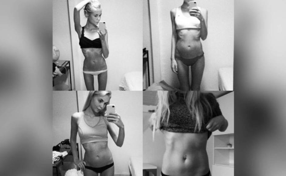 La anorexia es un desorden alimenticio que afecta a miles de jóvenes en el mundo.
