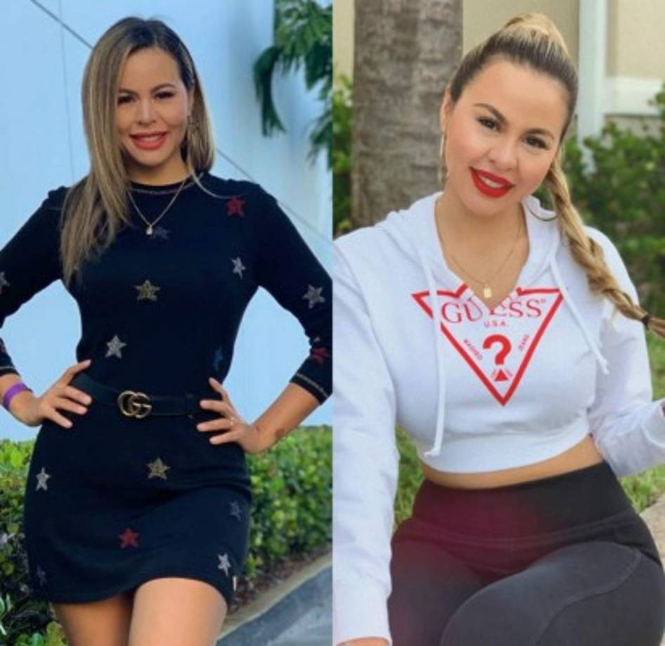 La otra cirugía de Lipstickfables fue la bichectomia, que es la extracción de depósitos de grasa en las mejillas para reducir su tamaño.