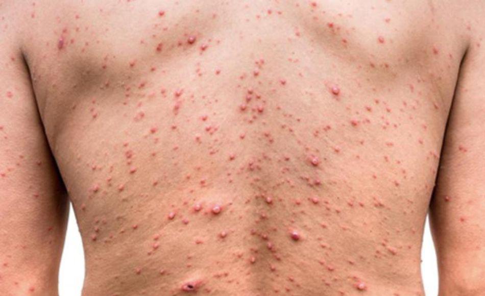 Piden a Salud reforzar fronteras ante amenaza por viruela del mono en Honduras