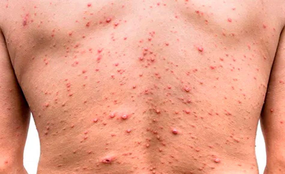 Pacientes hondureños con viruela del mono son atendidos con acetaminofén