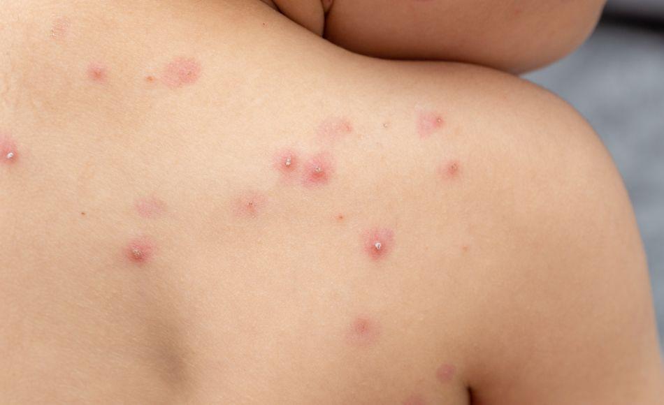 El brote de viruela del mono en países no endémicos supera los 2,000 casos