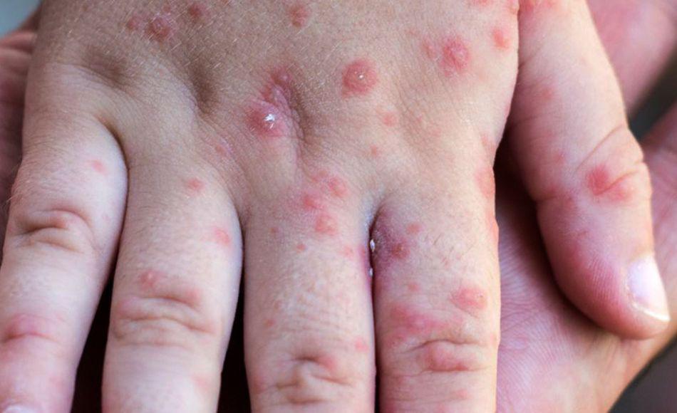 Suben a 21 los casos de viruela del mono en Estados Unidos