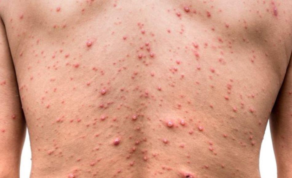 EEUU espera contener viruela del mono pero trabaja por si se vuelve endémica