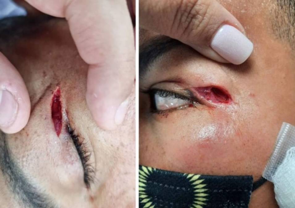 El Marathón publicó en sus redes sociales estas fuertes imágenes de como quedó la ceja de Mario Martínez tras el codazo que le propinó Jonathan Paz.
