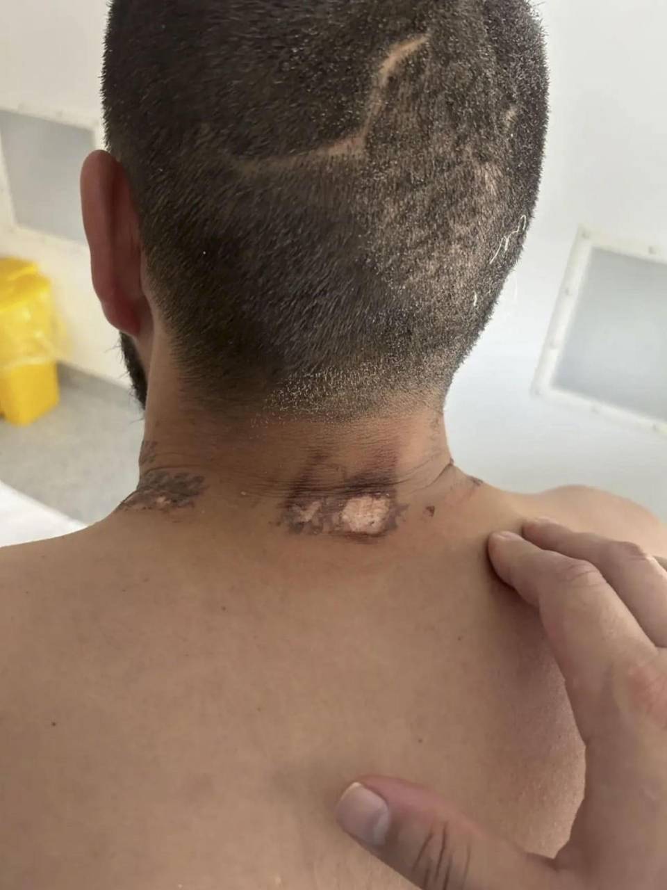 Cuando escuché la historia, no la creí hasta que hablé con el héroe personalmente. Pero es completamente cierta, afirmó en redes sociales Dmitri Jubézov, ministro de Sanidad de la región siberiana, quien visitó en el hospital al hombre, un veterano de guerra. -EFE/VK / ministro de Sanidad de la región de Altái