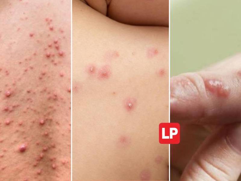 La Organización Mundial de la Salud (OMS) declaró este sábado una emergencia sanitaria internacional, su máximo nivel de alerta, por el actual brote de viruela del mono en el mundo.