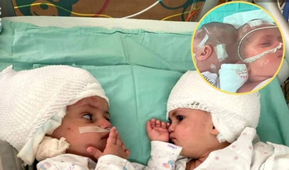 Las gemelas israelíes fueron separadas tras nacer unidas por la parte posterior de la cabeza. Se vieron por primera vez tras una operación exitosa realizada en aquel mismo país. Las gemelas tienen un año de edad. Fotografía captura de pantalla de NBC