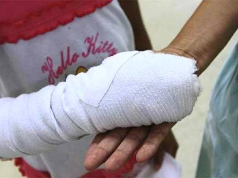 <b>Secuela. Una niña muestra la lesión que le dejó un mortero.</b>