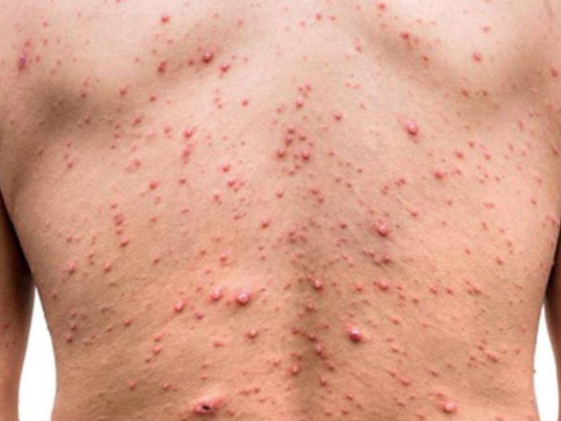 La especialista llamó a las autoridades de Salud a reforzar la vigilancia en los puntos fronterizos de Honduras.