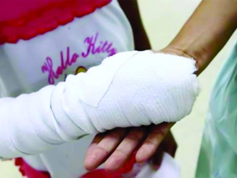 <b>Una niña con quemadura por pólvora es atendida en el hospital Mario Rivas. Foto: LA PRENSA</b>