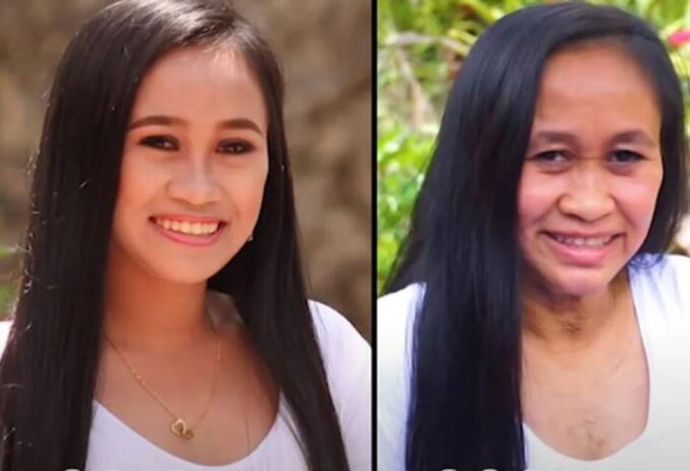 Raizel Calago, una adolescente filipina de 16 años de edad, “envejeció” unos 30 años en pocas semanas tras ser diagnosticada con un extraño trastorno genético, informaron medios internacionales.