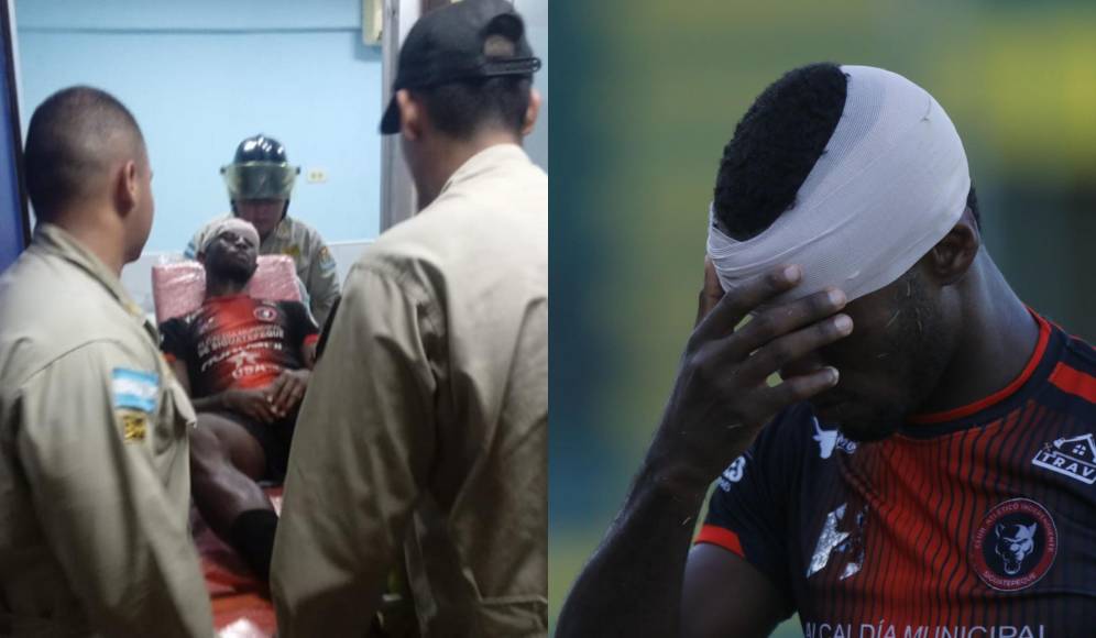 El duelo del pasado sábado entre Parrillas One e Independiente dejó un zafarrancho en la Liga de Ascenso. En las últimas horas se han viralizado fuertes imágenes de las heridas que sufrieron algunos jugadores.