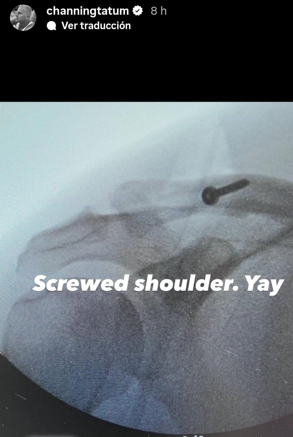 Radiografía del hombro de Channing Tatum después de la cirugía, se aprecia el tornillo que le tuvieron que colocar.