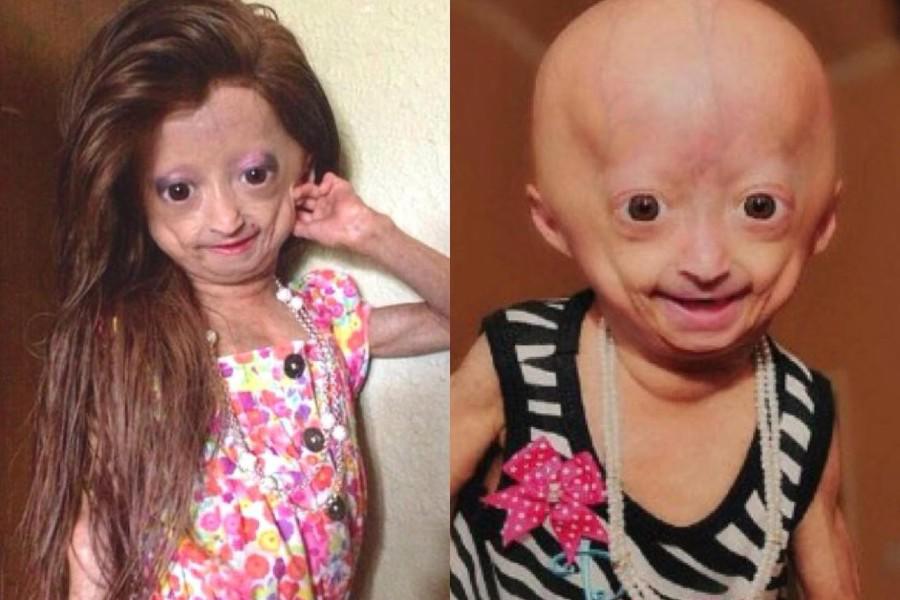 La progeria, también conocida como “síndrome de Hutchinson-Gilford”, es un trastorno genético progresivo extremadamente raro que acelera el envejecimiento de los niños.